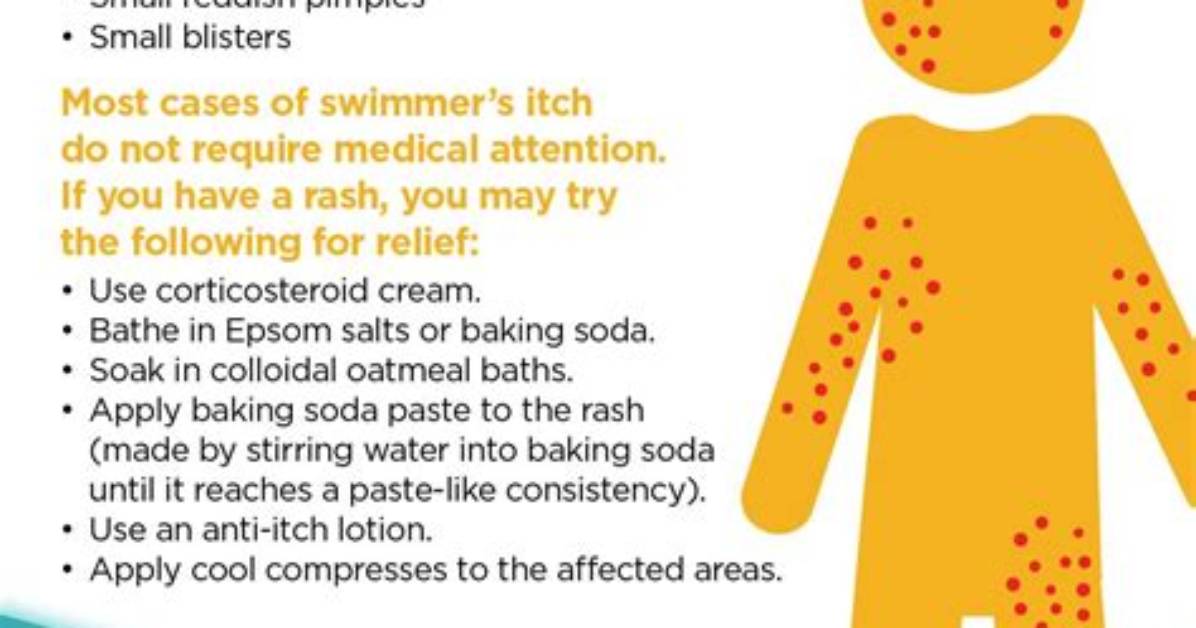 Does Chlorine Kill Swimmers Itch?
