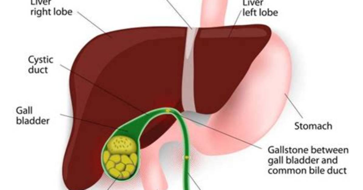 Does Cholecystitis Go Away?