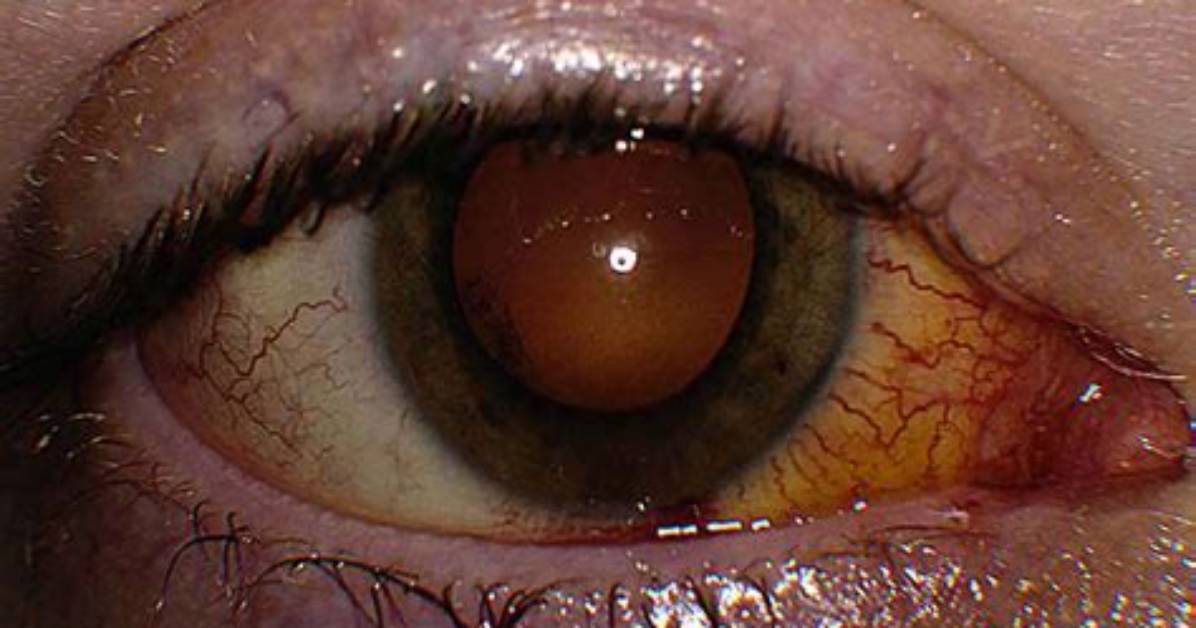 Does Chorioretinitis Causes Blindness?