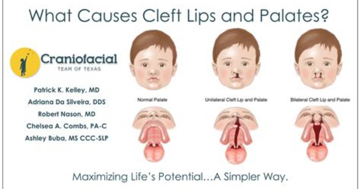 Does Cleft Palate Skip Generation?