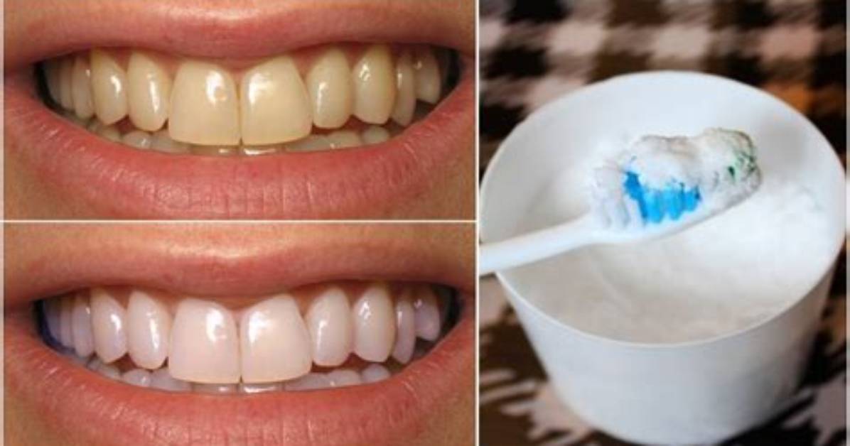 Does Clove Whiten Teeth?