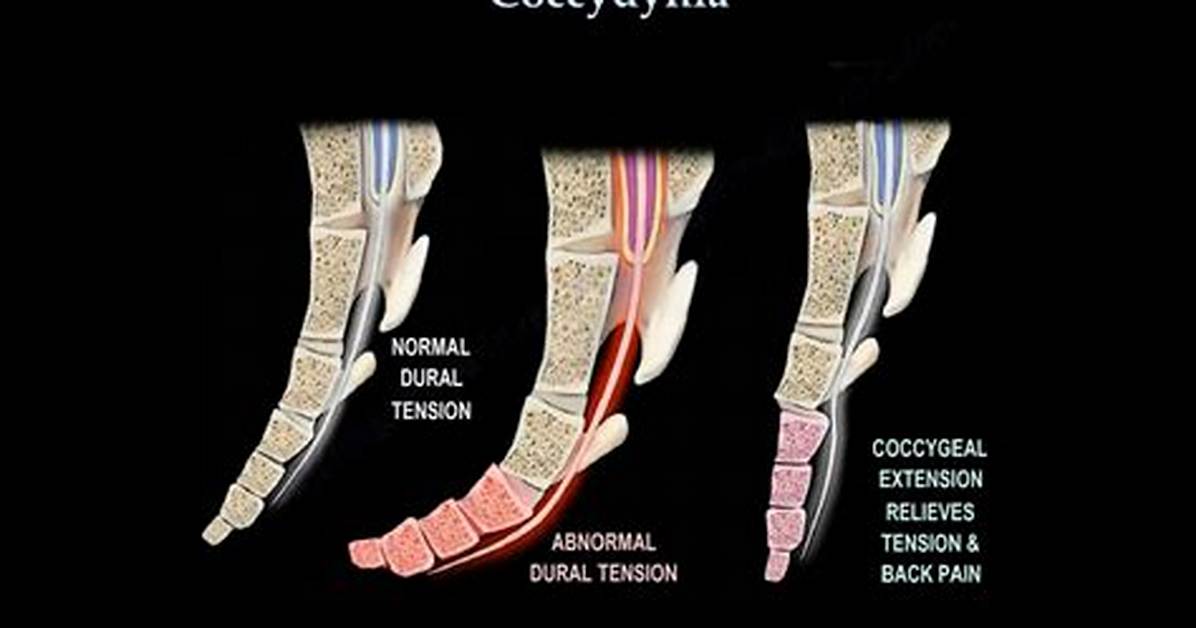 Does Coccydynia Cause Swelling?