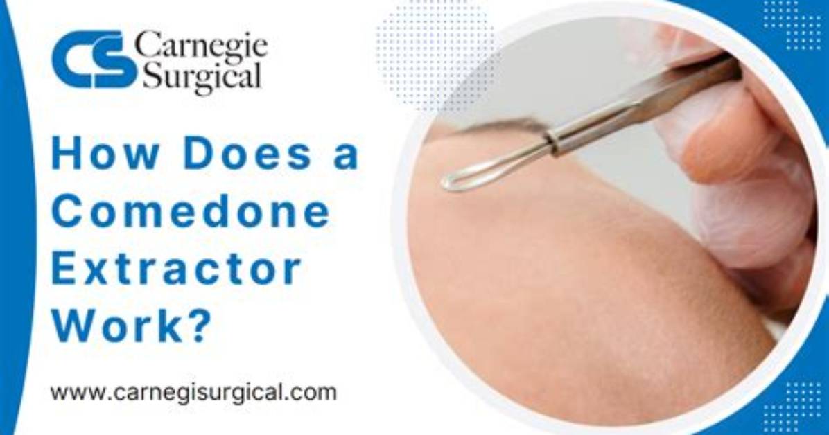 Does Comedone Extractor Work?