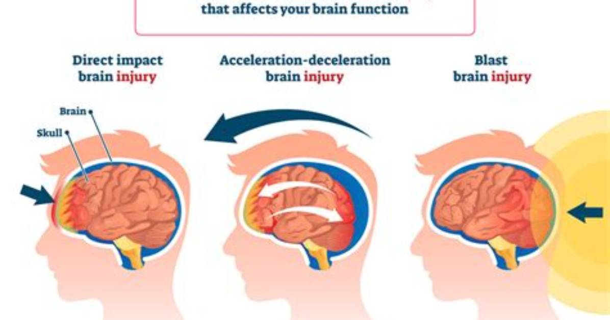 Does Concussions Cause Dizziness?