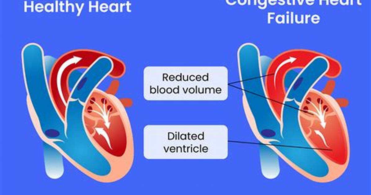 Does Copd Lead to Congestive Heart Failure