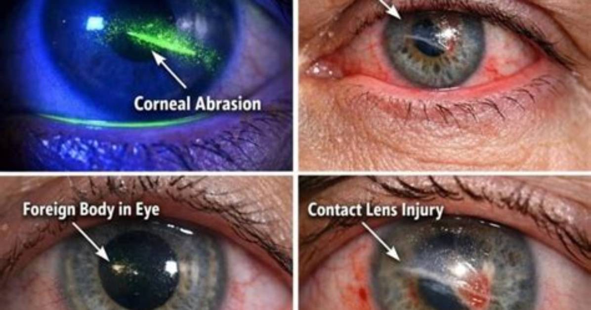 Does Corneal Abrasion Need Surgery?
