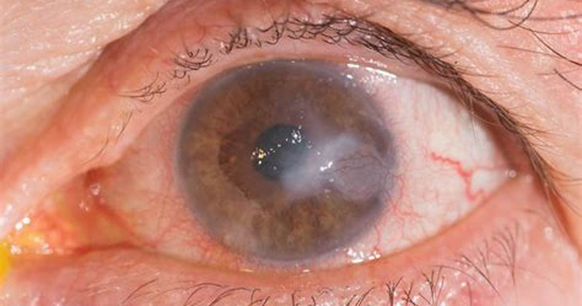 Does Corneal Infiltrate Stain?