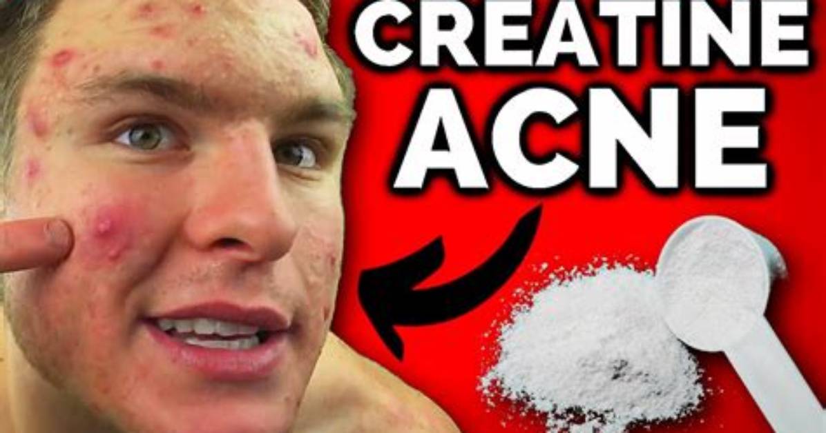 Does Creatine Cause Acne?