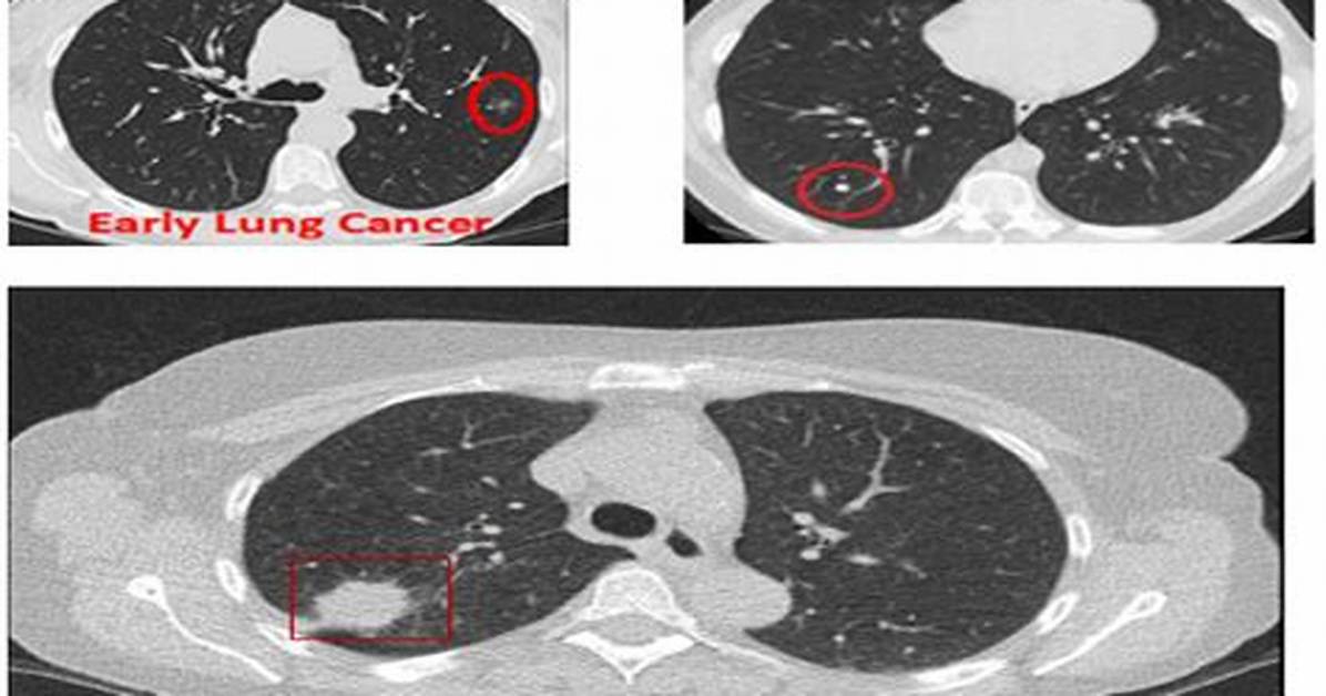 Does Ct Scan Show Lung Inflammation?