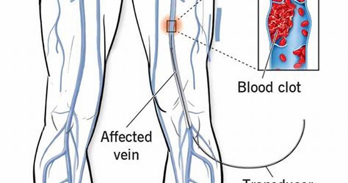 Does Ct Venogram Use Contrast?
