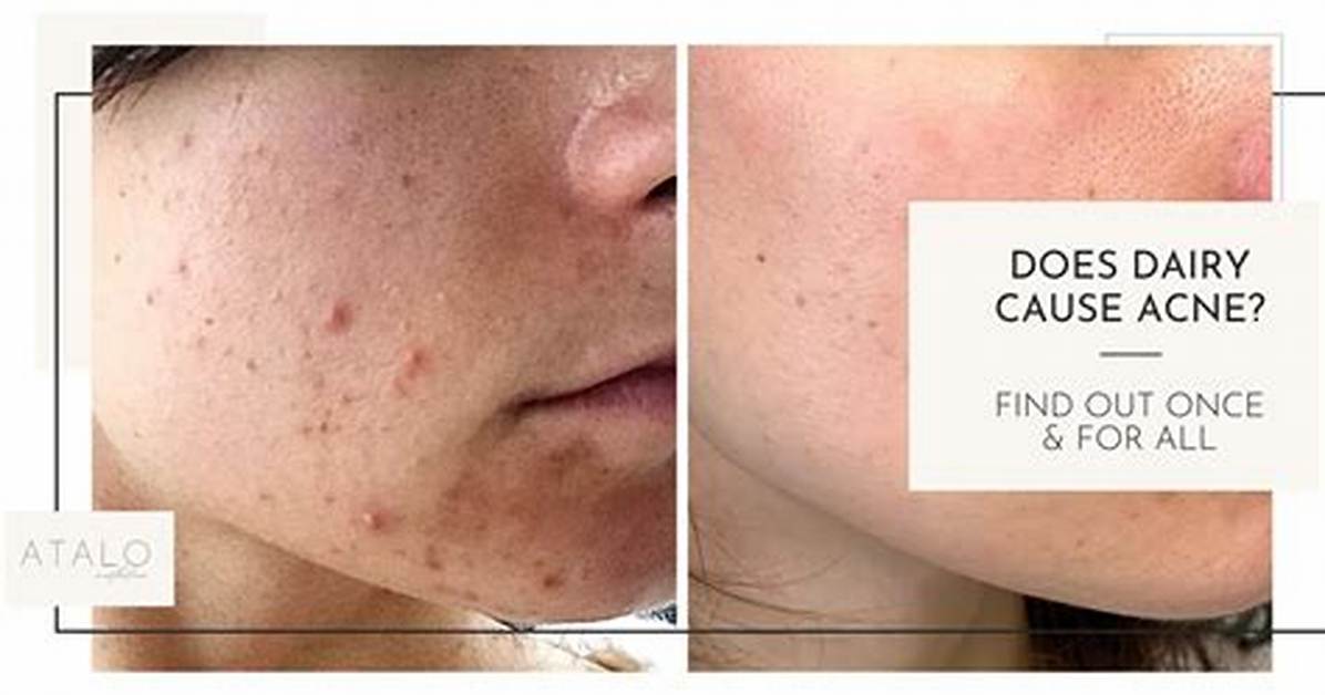 Does Dairy Cause Acne?