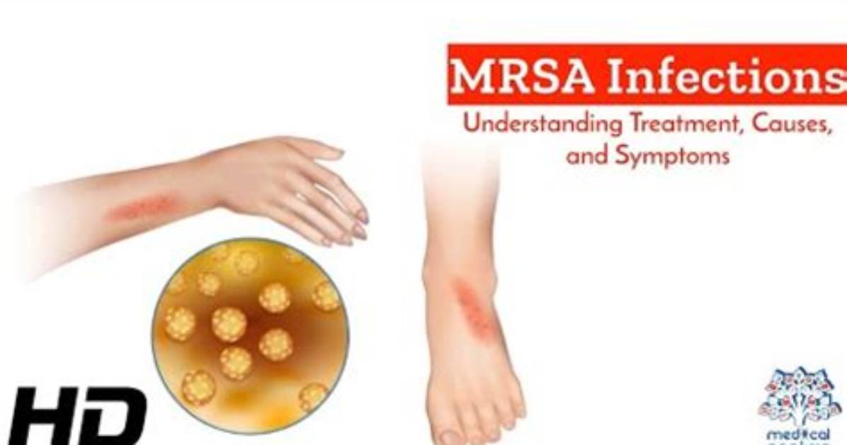 Does Dalvance Treat Mrsa