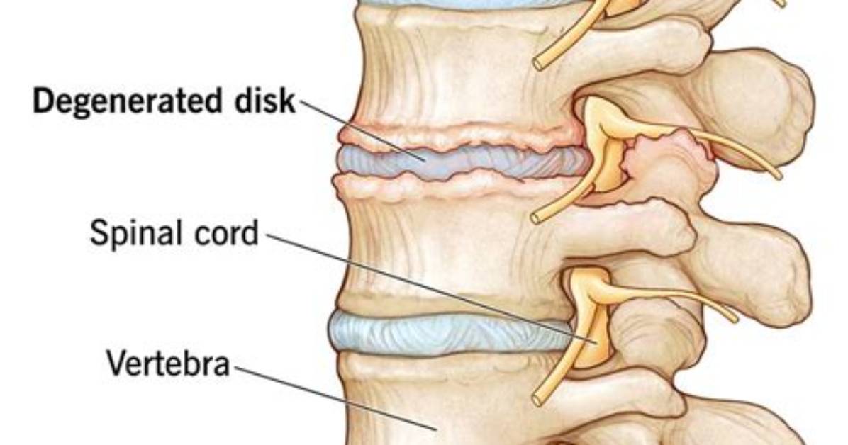 Does Degenerative Discs Cause Knee Pain?