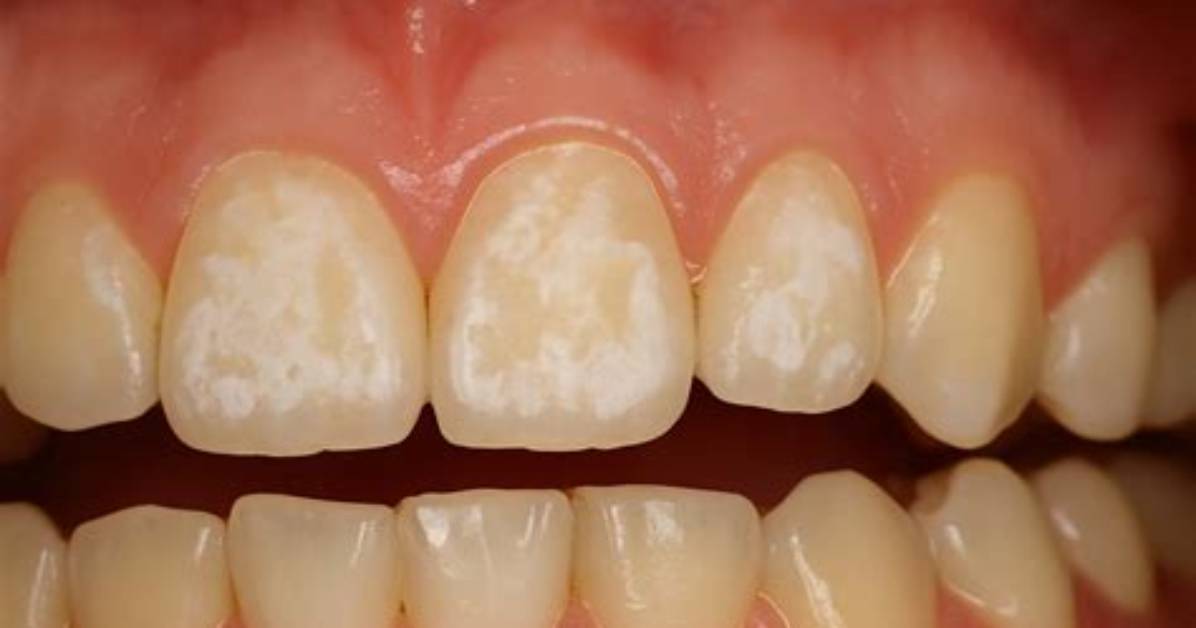 Does Demineralization Cause Tooth Decay?