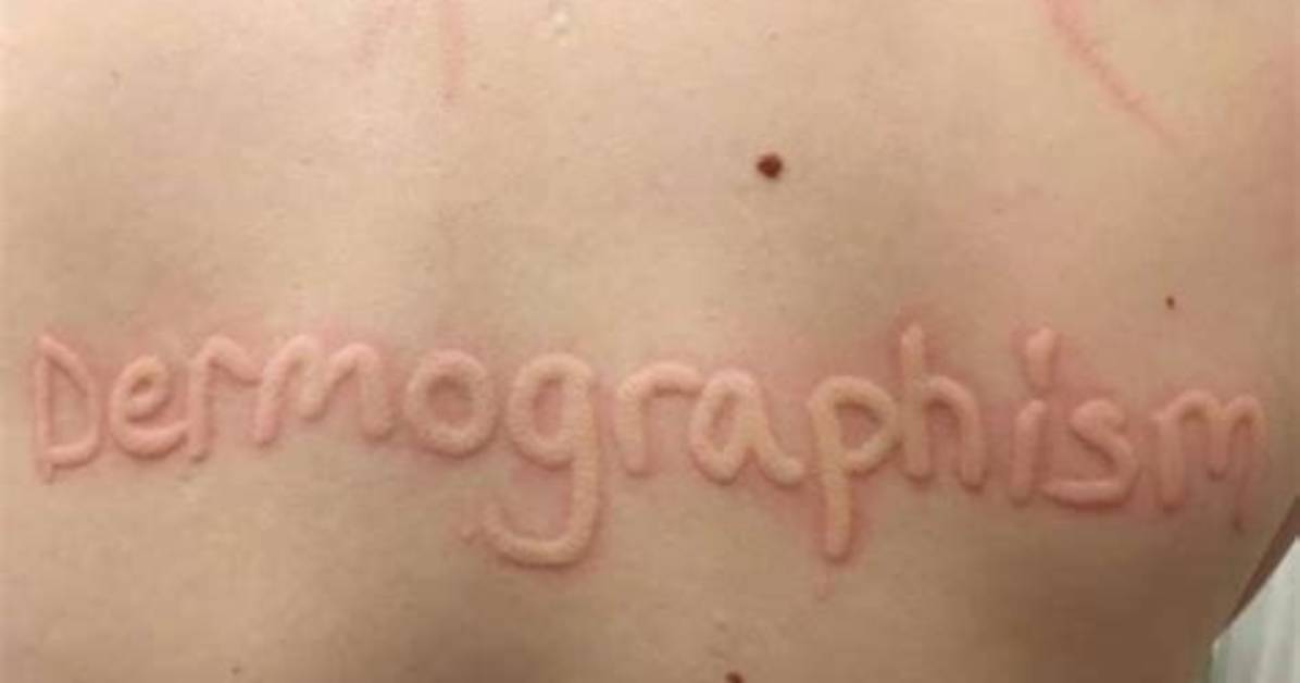 Does Dermographism Go Away