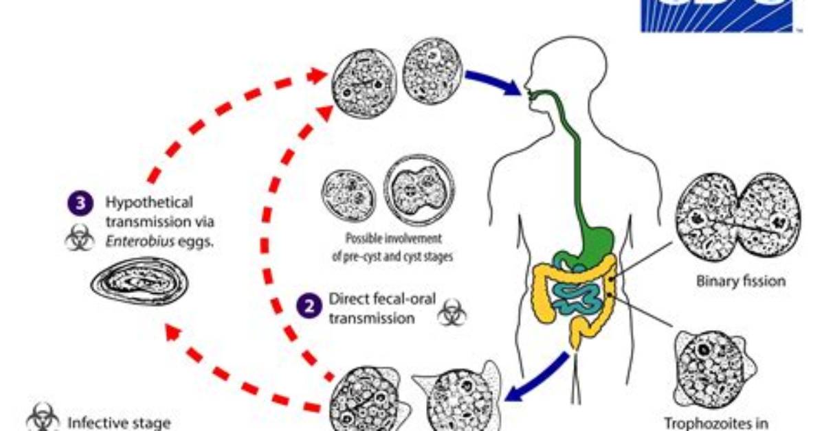 Does Dientamoeba Fragilis Need to Be Treated?