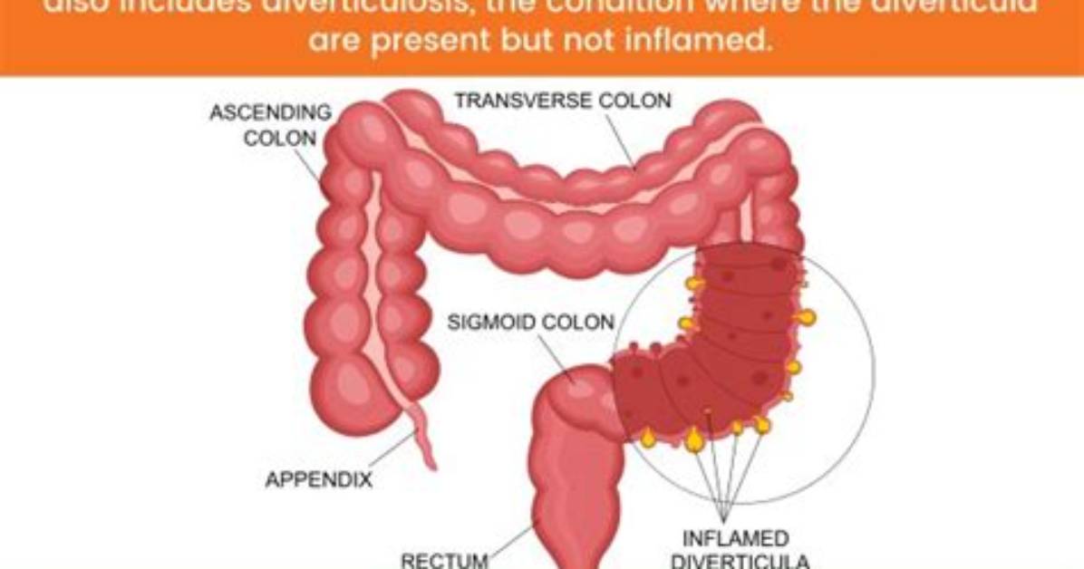 Does Diverticulitis Cause Tenesmus?