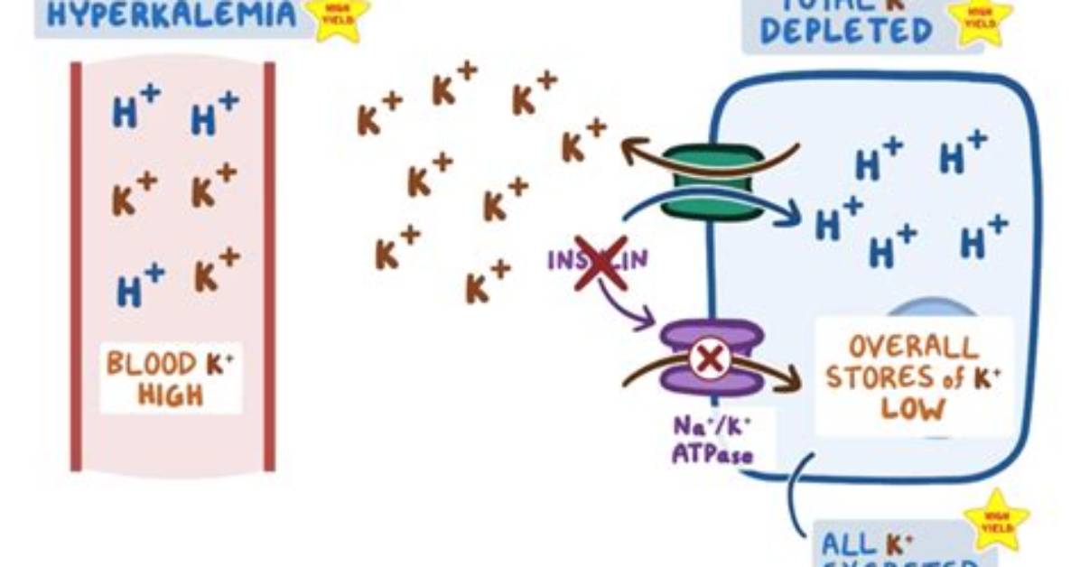 Does Dka Cause Hypokalemia?