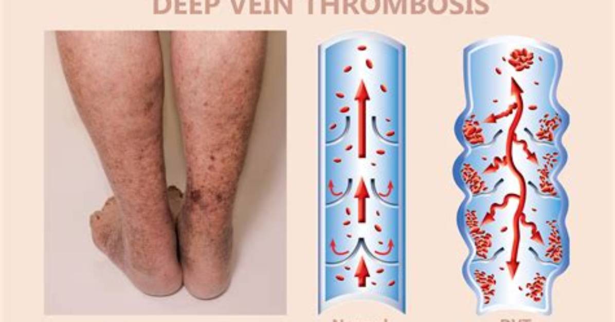 Does Dvt Hurt More When Lying Down?