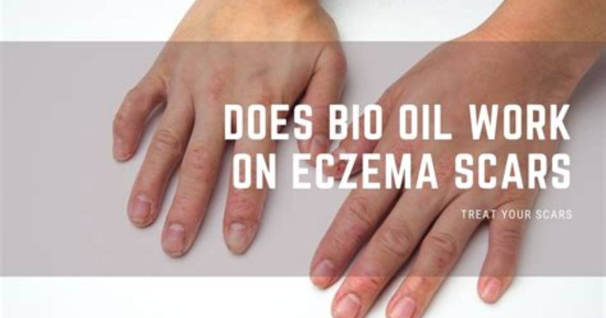 Does Eczema Leave Scars?