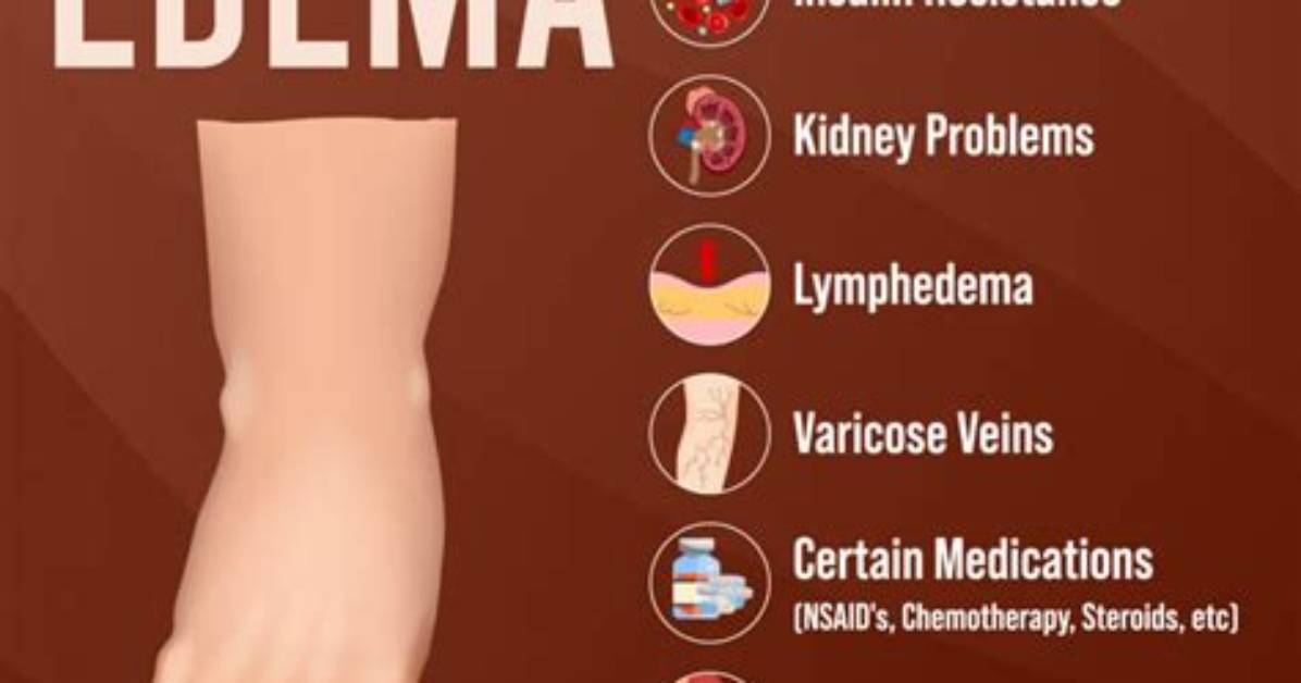 Does Edema Hurt