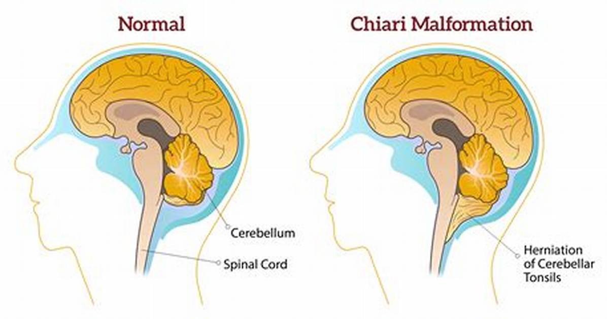 Does Eds Cause Chiari Malformation?