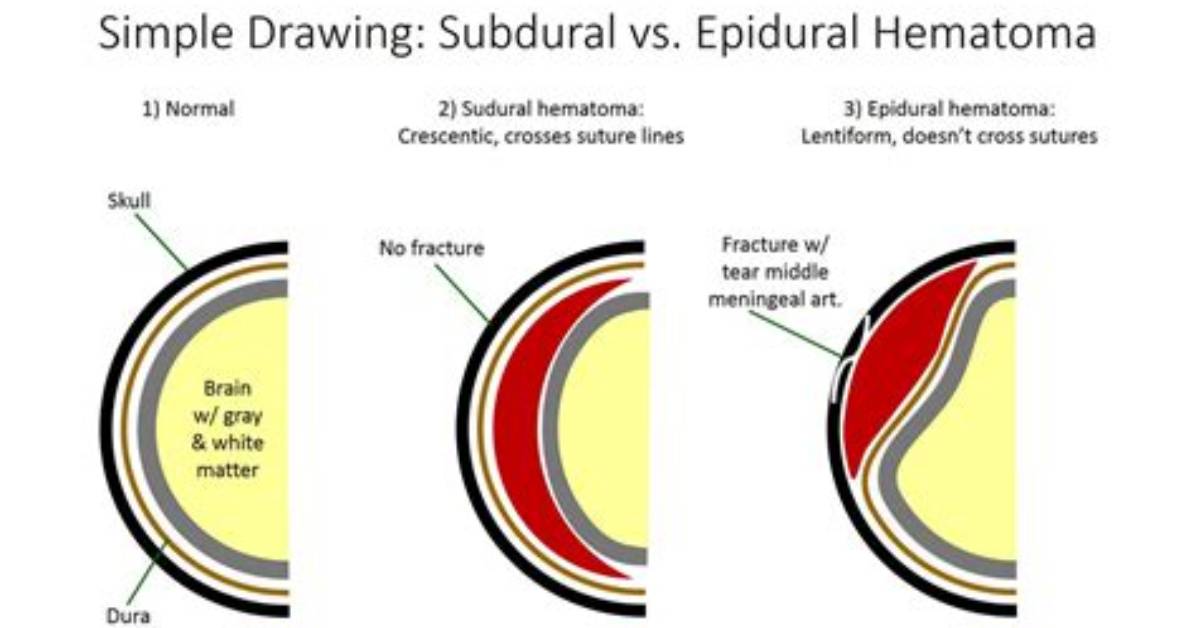 Does Epidural Hematoma Cross Midline