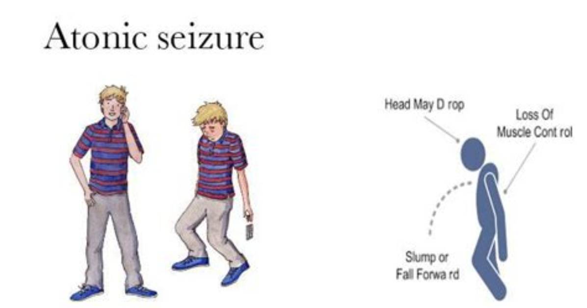 Does Epilepsy Cause Atonic Seizure?