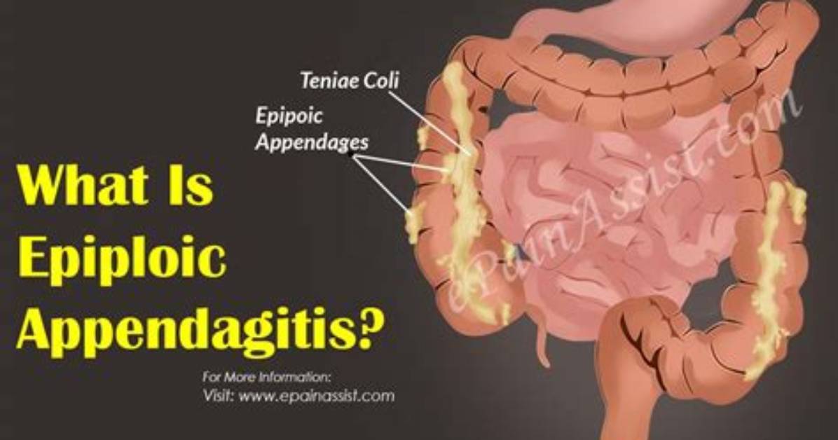 Does Epiploic Appendagitis Cause Diarrhea?