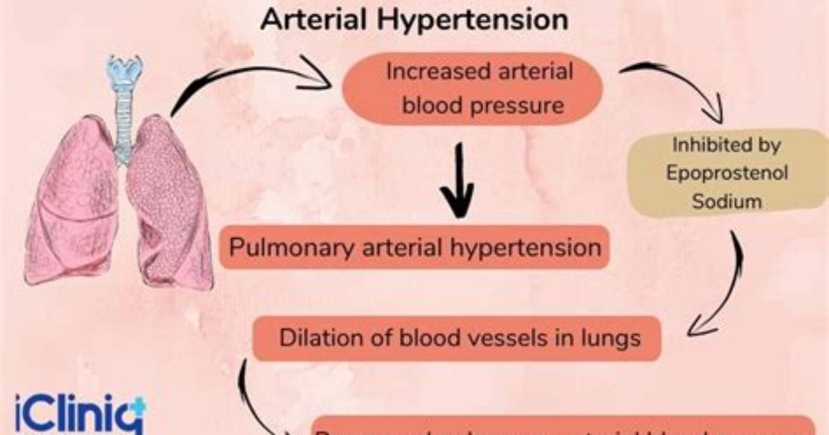 Does Epoprostenol Cause Bleeding?