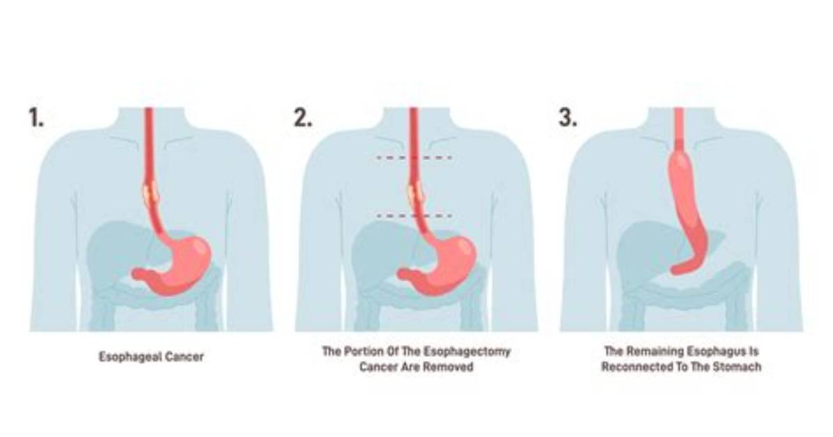 Does Esophagectomy Cause Diarrhea?
