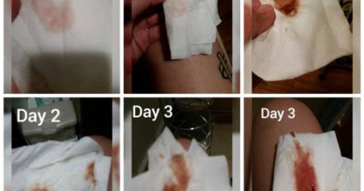Does Everyone Get Implantation Bleeding?
