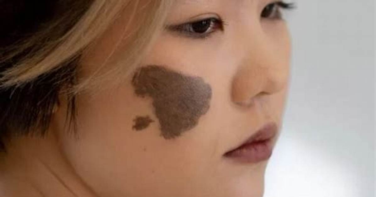 Does Everyone Have a Birthmark?