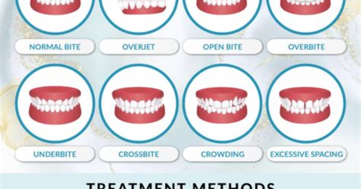 Does Everyone Have an Overbite