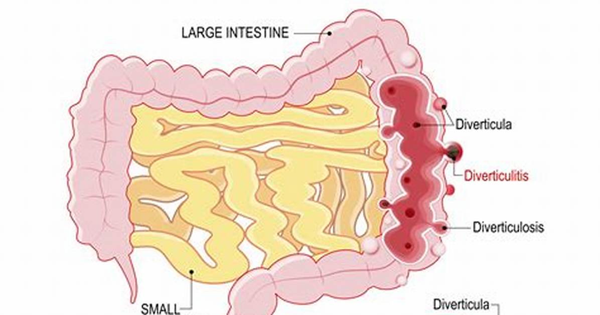 Does Everyone Have Diverticula?