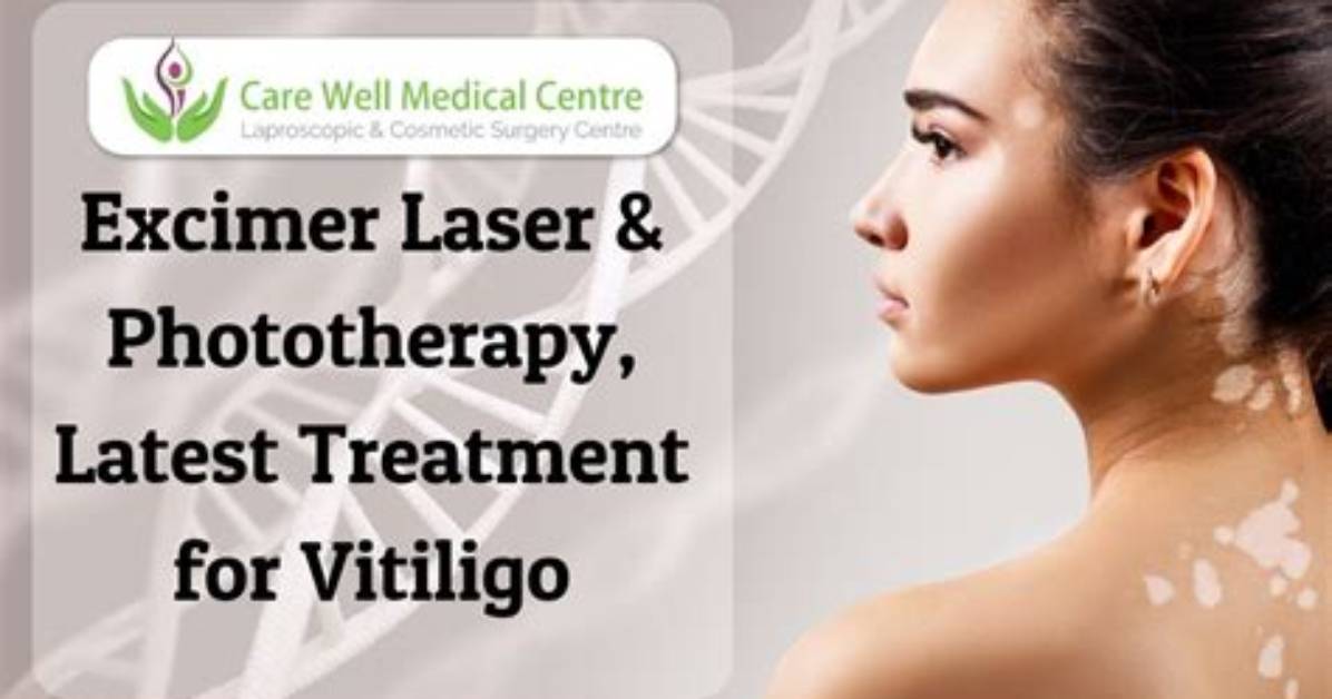 Does Excimer Laser Work for Vitiligo?