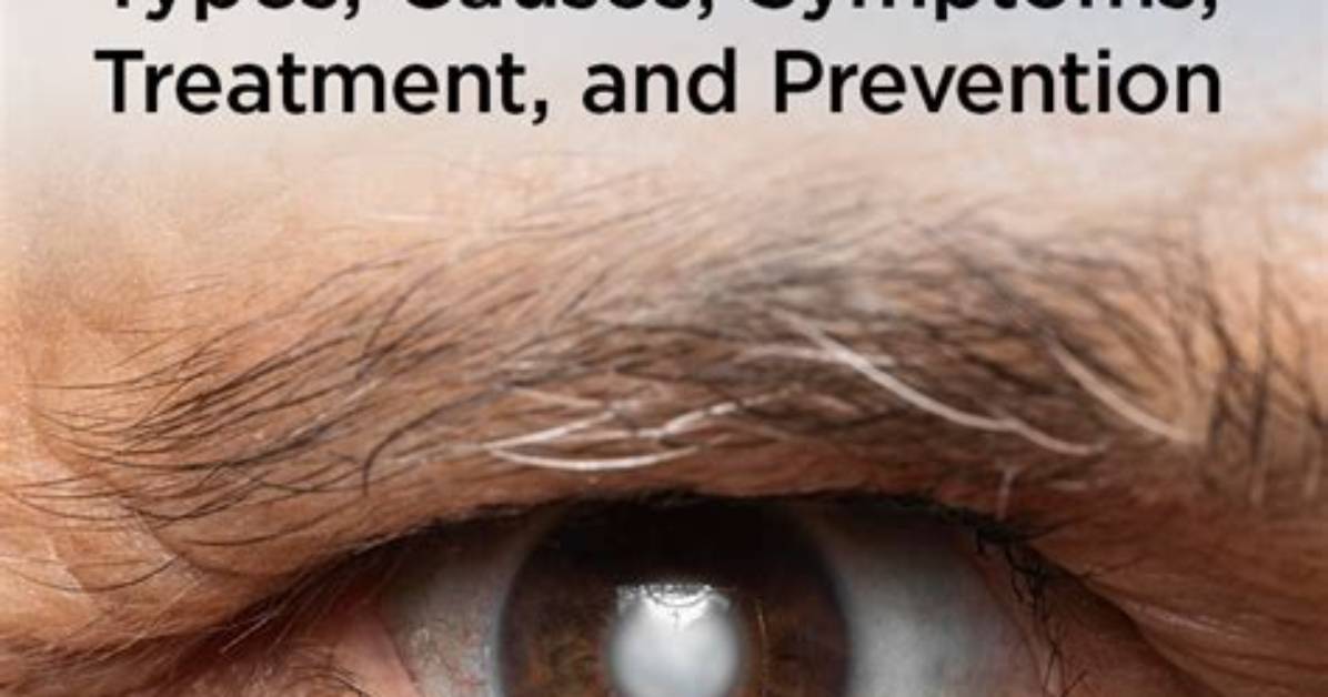 Does Eylea Cause Cataracts?