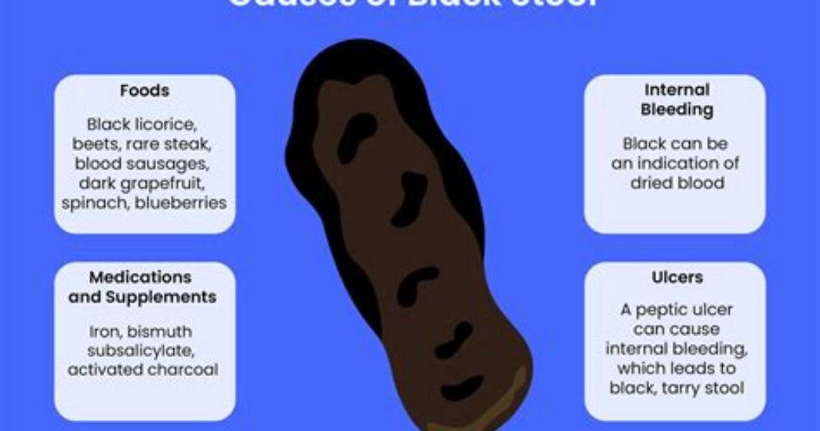 Does Feosol Cause Dark Stool?