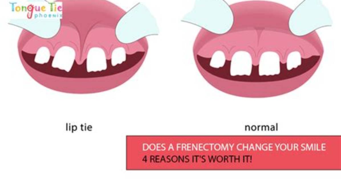 Does Frenectomy Affect Smile