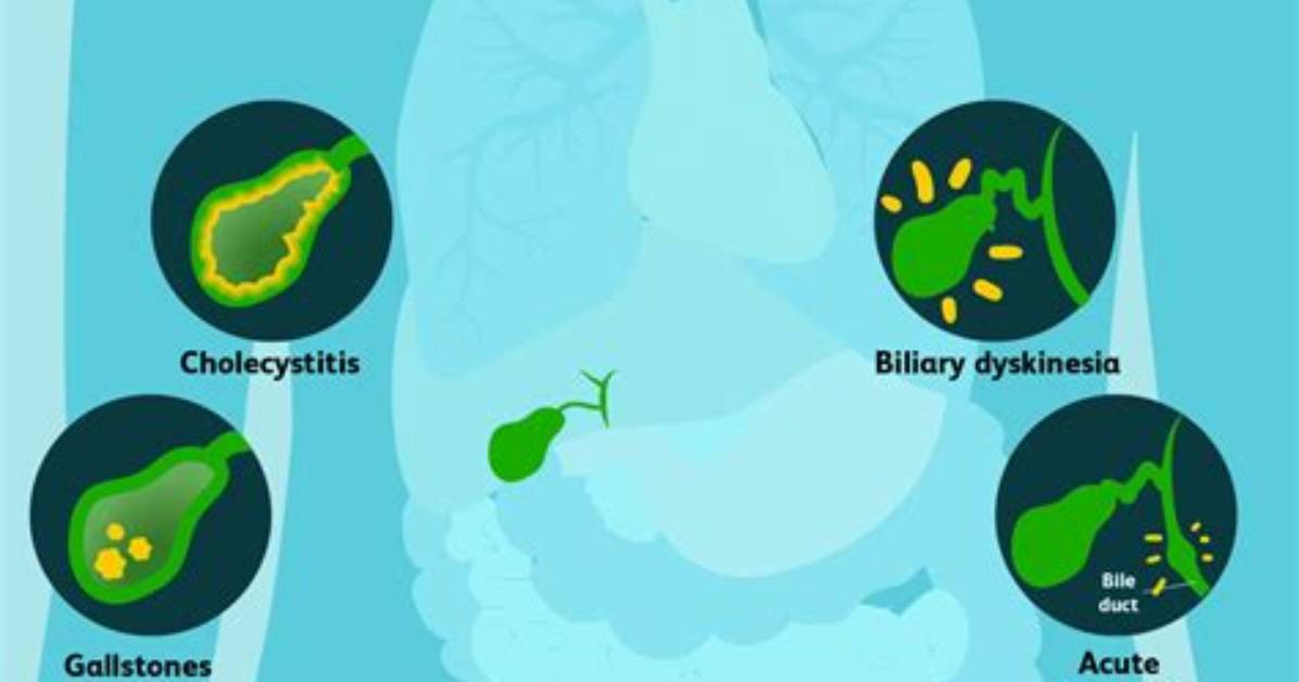 Does Gallbladder Issues Cause Constipation?