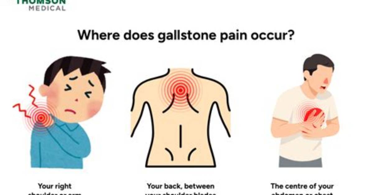 Does Gallstones Cause Back Pain?