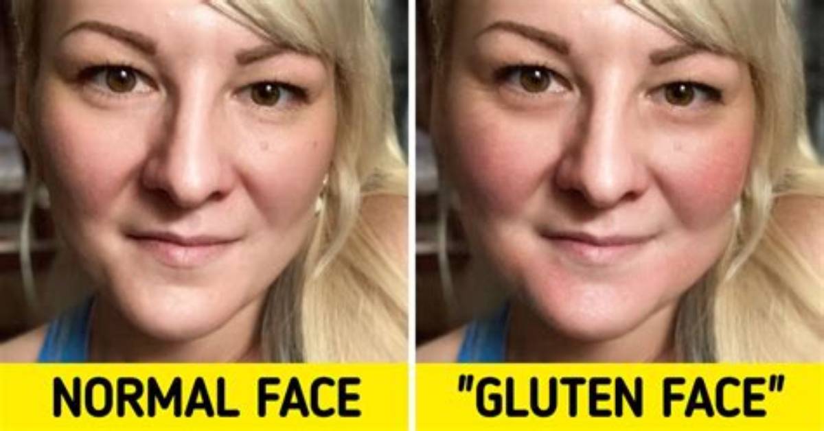 Does Gluten Affect Your Eyes?
