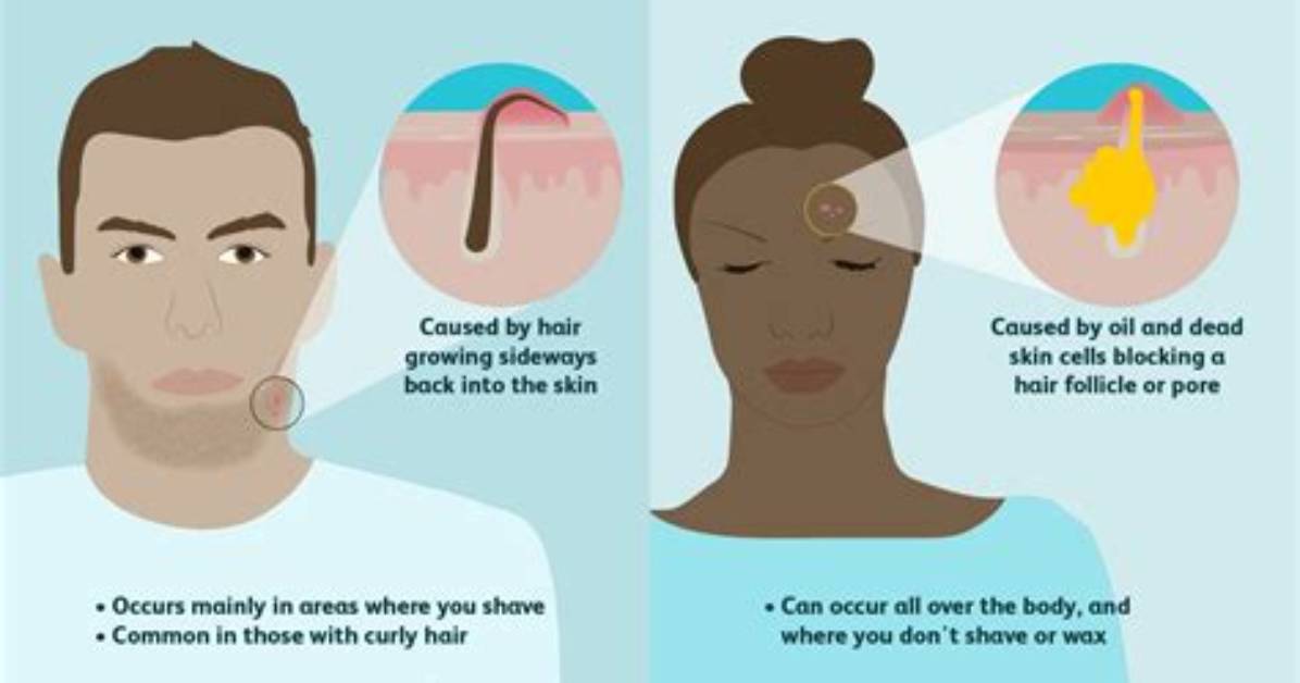 Does Growing Hair Cause Pimples?