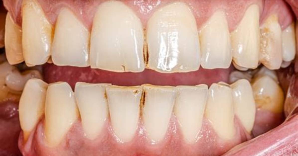 Does Gum Stain Your Teeth?