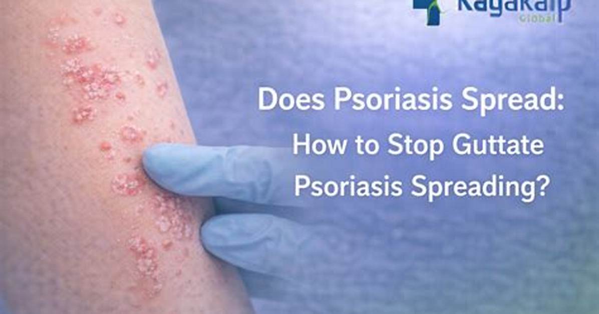 Does Guttate Psoriasis Spread?