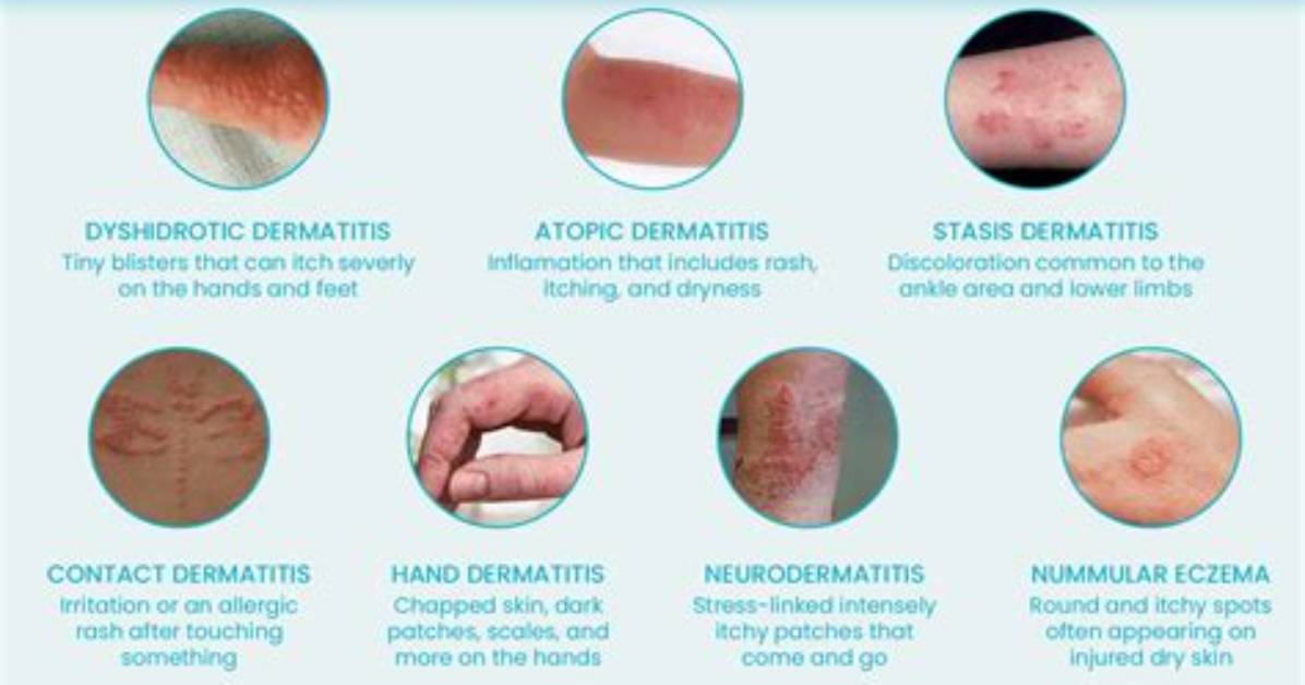 Does Hazelwood Help Eczema