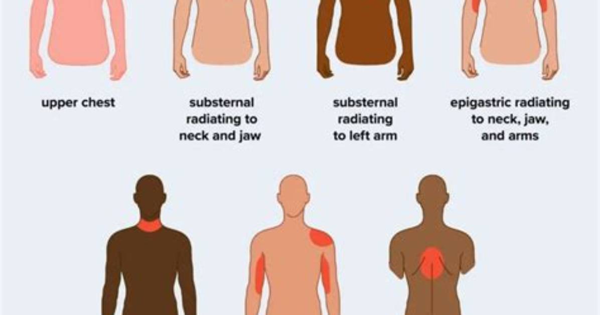 Does Heart Attack Pain Go Away?