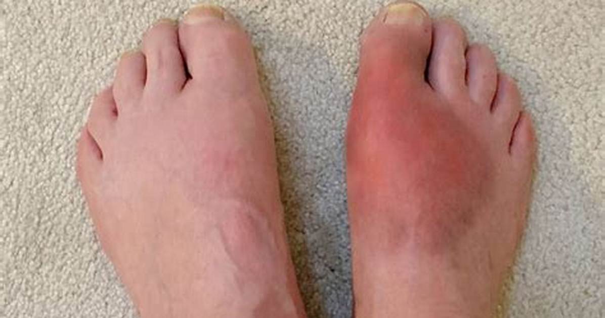 Does Heat Affect Gout