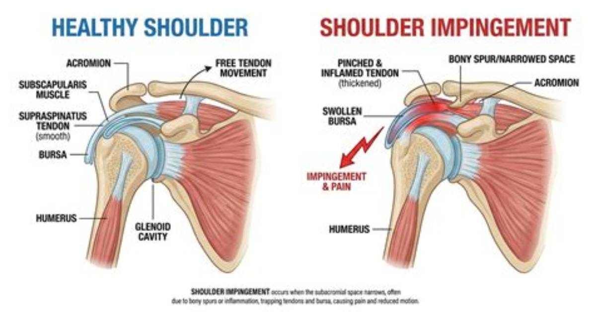 Does Heat Help Shoulder Impingement?
