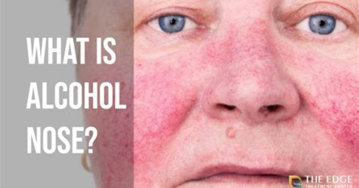 Does Heavy Drinking Cause Red Nose?
